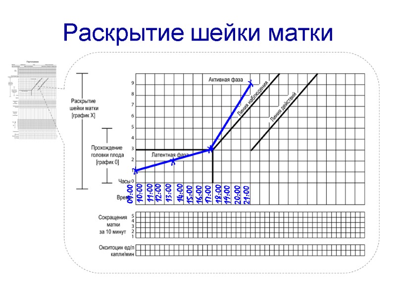 Раскрытие шейки матки  09:00 10:00 11:00 12:00 13:00 14:00 15:00 16:00 17:00 18:00